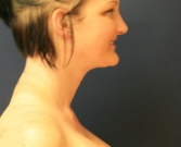 Feel Beautiful - Liposuction Neck San Diego Case 10 - After Photo